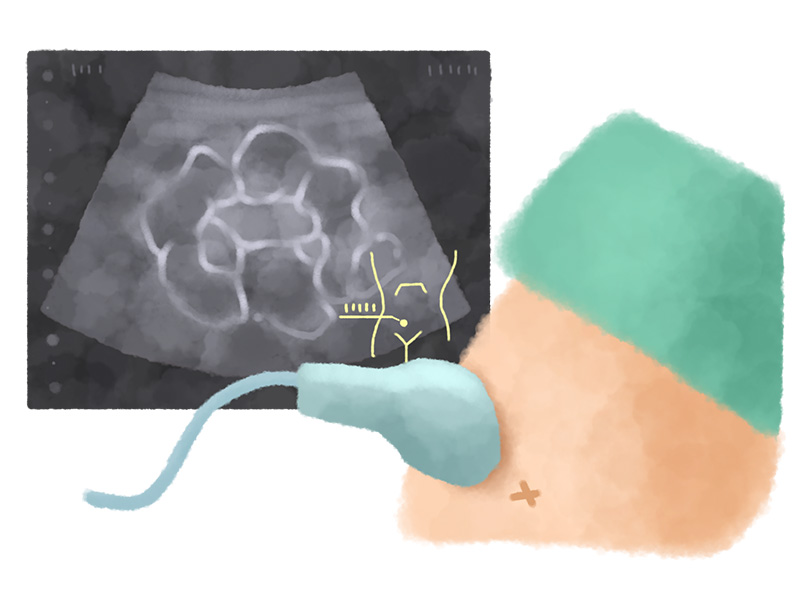 エコー（超音波検査）